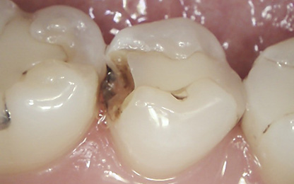 長崎市坂本・工藤デンタルクリニック・歯科用CT