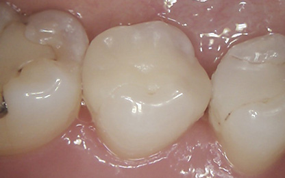 長崎市坂本・工藤デンタルクリニック・歯科用CT